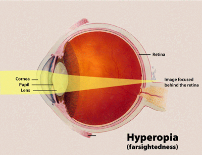Hyperopia - farsightedness